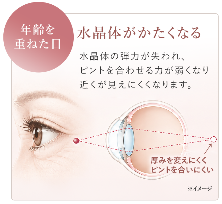 年齢を重ねた目で水晶体がかたくなった状態